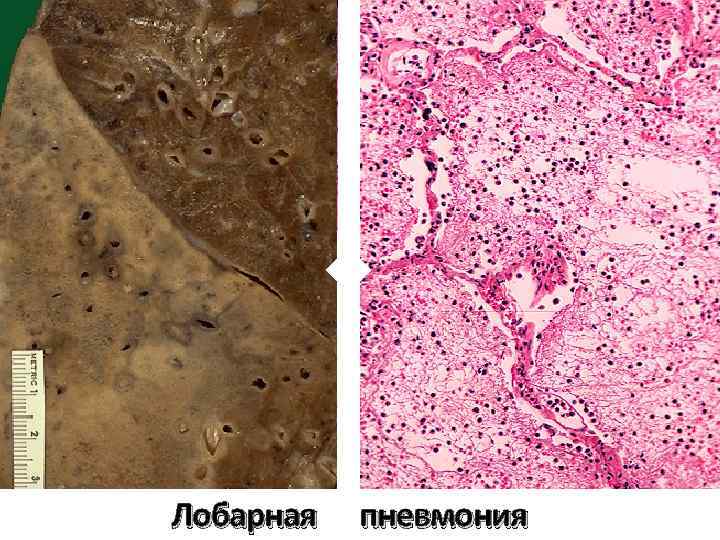 Крупозный трахеит микропрепарат рисунок