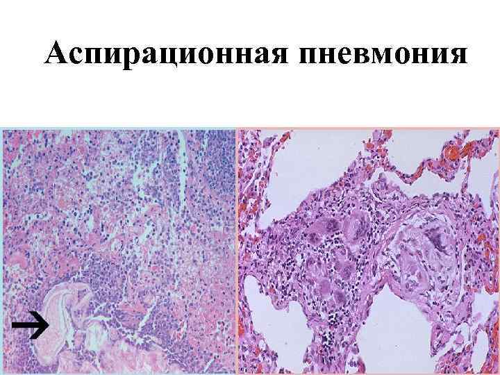 Аспирационная пневмония