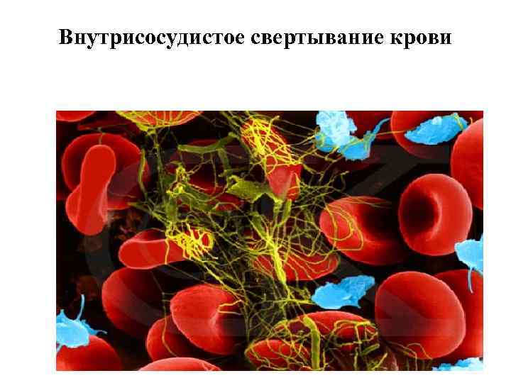 Внутрисосудистое свертывание крови 