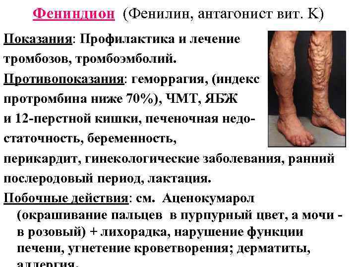 Фениндион (Фенилин, антагонист вит. K) Показания: Профилактика и лечение тромбозов, тромбоэмболий. Противопоказания: геморрагия, (индекс