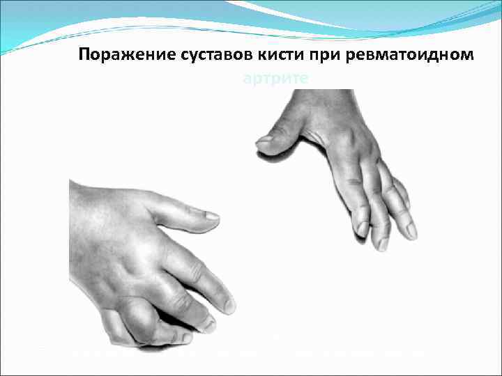 Поражение суставов кисти при ревматоидном артрите 