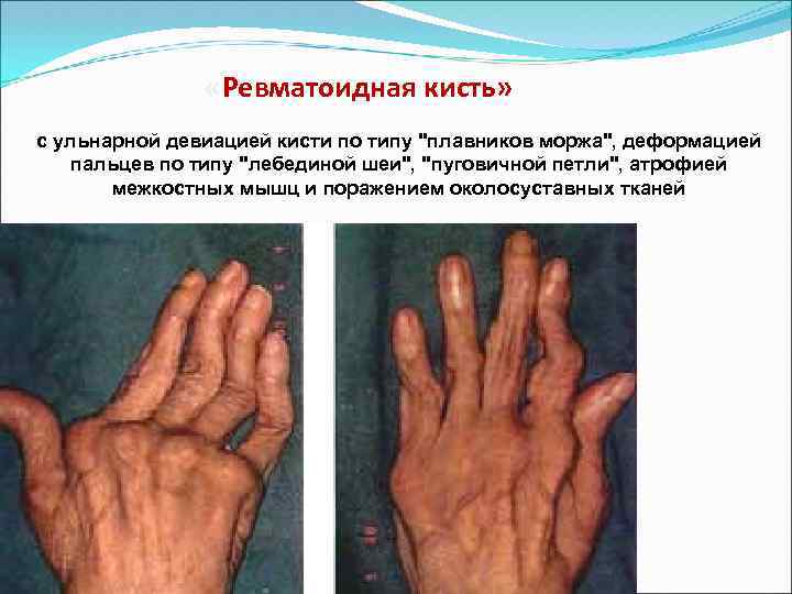  «Ревматоидная кисть» с ульнарной девиацией кисти по типу "плавников моржа", деформацией пальцев по