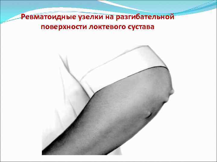 Ревматоидные узелки на разгибательной поверхности локтевого сустава 