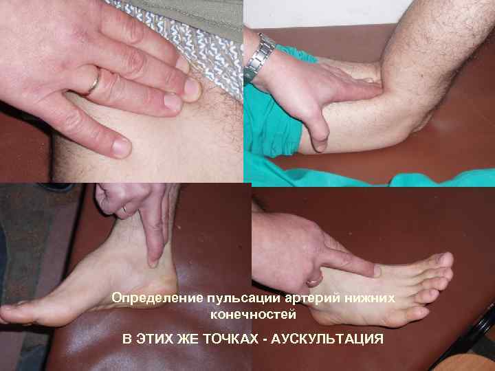 Определение пульсации артерий нижних конечностей В ЭТИХ ЖЕ ТОЧКАХ - АУСКУЛЬТАЦИЯ 15 