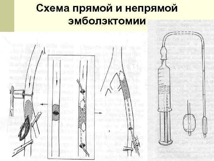 Схема операции удаления эмбола из бифуркации аорты