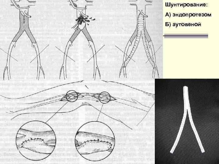 Шунтирование: А) эндопротезом Б) аутовеной 31 