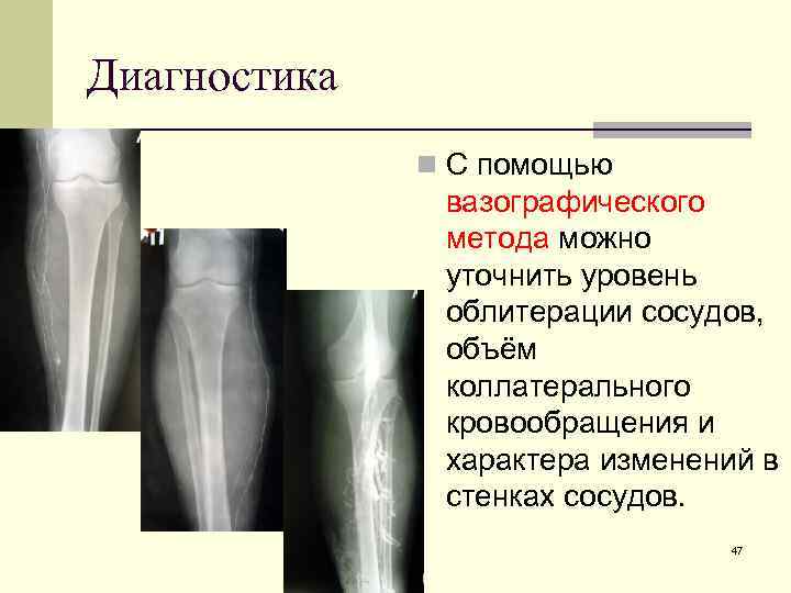Диагностика n С помощью вазографического метода можно уточнить уровень облитерации сосудов, объём коллатерального кровообращения