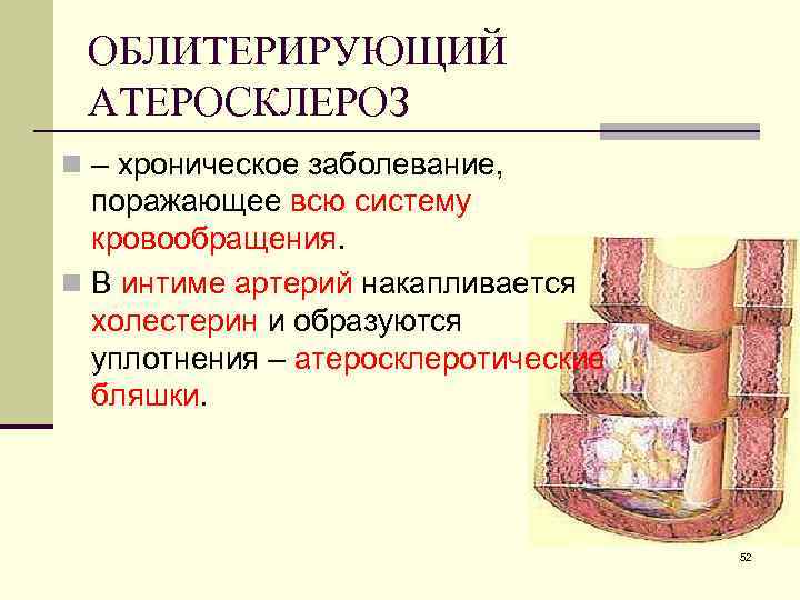 ОБЛИТЕРИРУЮЩИЙ АТЕРОСКЛЕРОЗ n – хроническое заболевание, поражающее всю систему кровообращения. n В интиме артерий