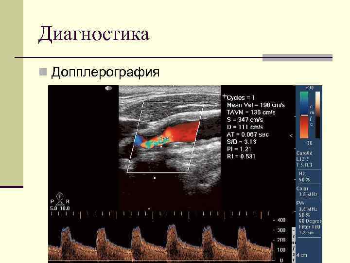 Диагностика n Допплерография 