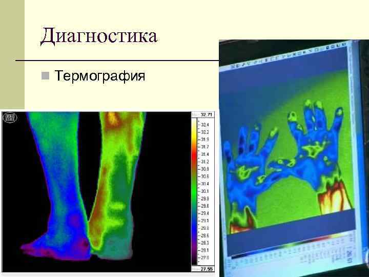 Диагностика n Термография 