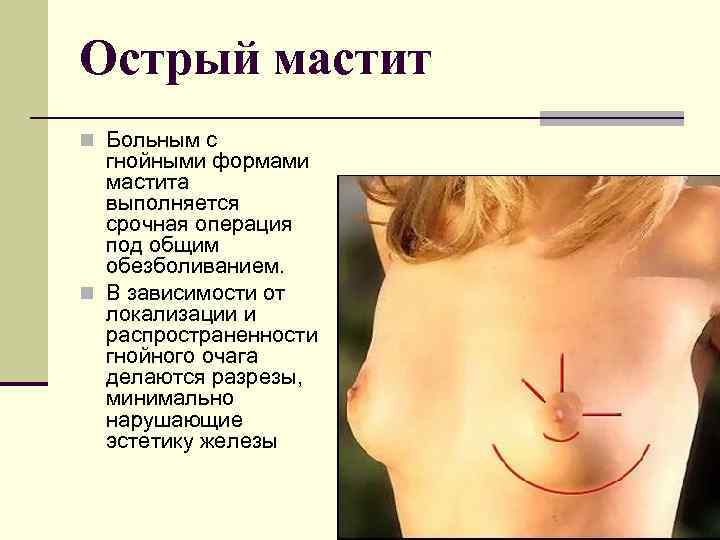 Острый мастит n Больным с гнойными формами мастита выполняется срочная операция под общим обезболиванием.