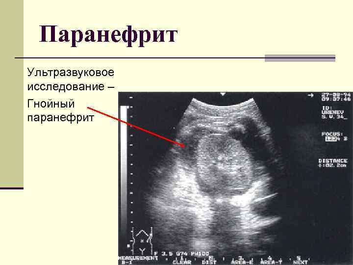 Паранефрит Ультразвуковое исследование – Гнойный паранефрит 