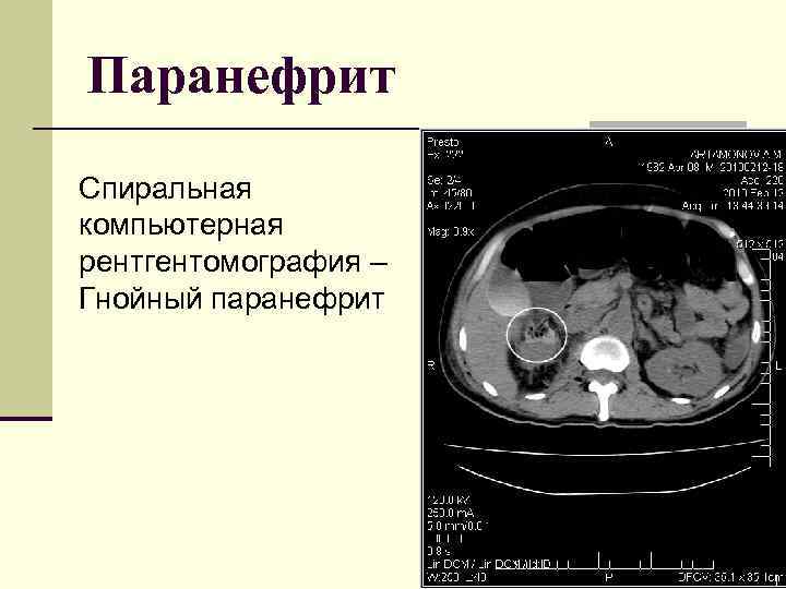 Паранефрит Спиральная компьютерная рентгентомография – Гнойный паранефрит 