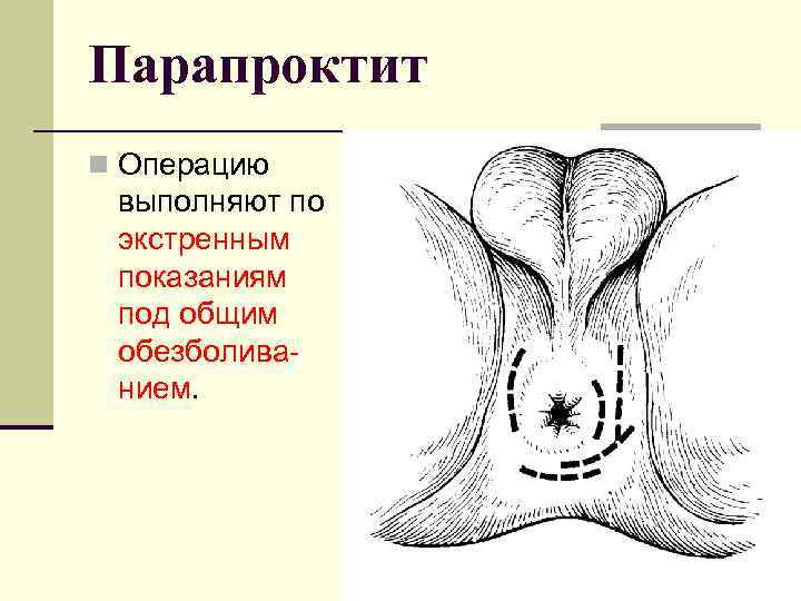 Парапроктит n Операцию выполняют по экстренным показаниям под общим обезболиванием. 