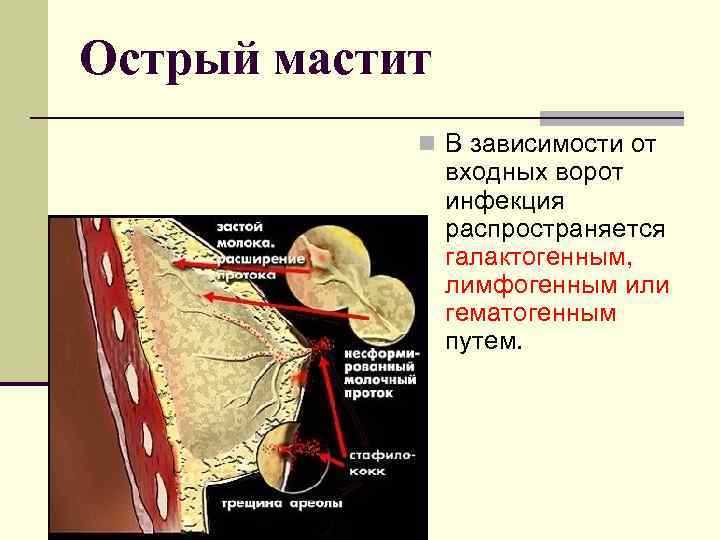 Острый мастит n В зависимости от входных ворот инфекция распространяется галактогенным, лимфогенным или гематогенным