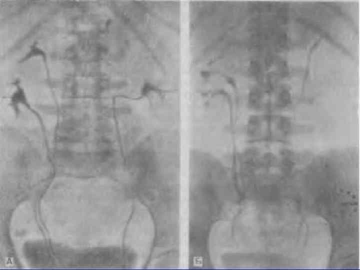 Нефроптоз левой. Удвоение почки экскреторная урография. Нефроптоз почек рентген. Удвоение ЧЛС экскреторная урография. Нефроптоз почки урография.