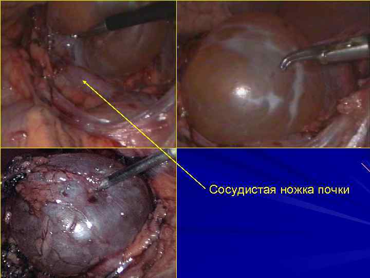 Сосудистая ножка почки 