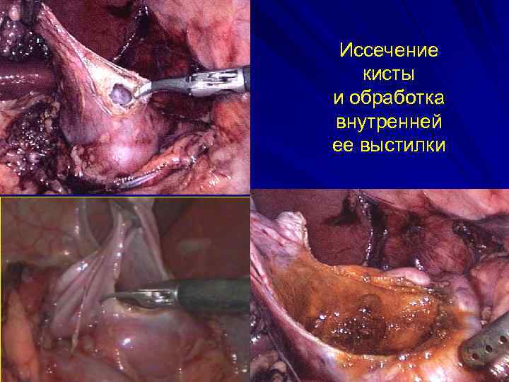 Иссечение кисты и обработка внутренней ее выстилки 