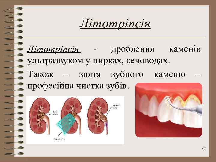 Літотріпсія дроблення каменів ультразвуком у нирках, сечоводах. Також – знятя зубного каменю – професійна