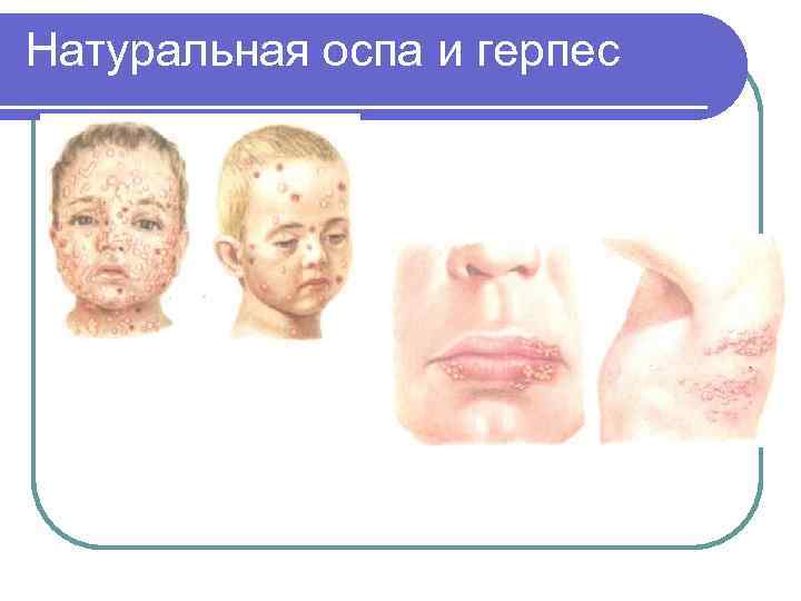 Натуральная оспа и герпес 
