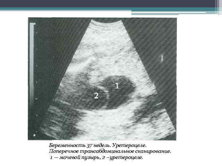 Беременность 37 недель. Уретероцеле. Поперечное трансабдоминальное сканирование. 1 — мочевой пузырь, 2 –уретероцеле. 