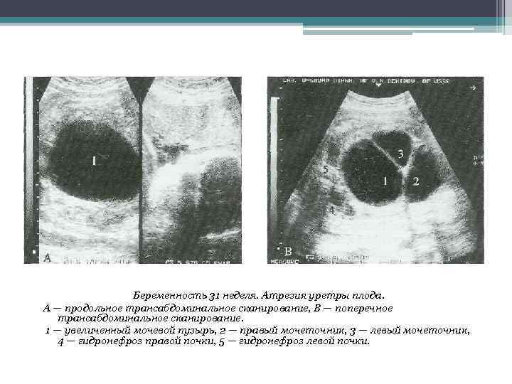 Беременность 31 неделя. Атрезия уретры плода. А — продольное трансабдоминальное сканирование, В — поперечное