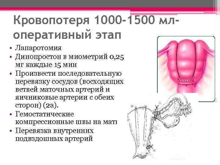 Перевязка маточных сосудов. Перевязка маточных артерий. Перевязка внутренних подвздошных артерий Акушерство. Перевязка маточных сосудов с обеих сторон. Перевязка восходящих ветвей маточных артерий.