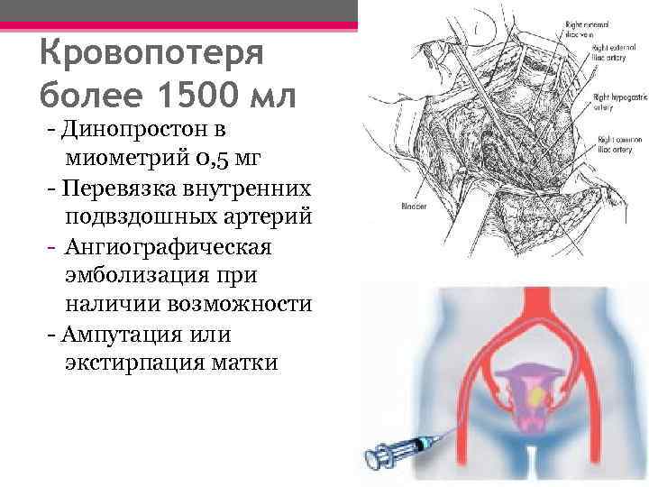 Перевязка маточных сосудов. Перевязка внутренних подвздошных артерий Акушерство. Перевязка внутренней подвздошной артерии. Последствия перевязки подвздошной артерии. Перевязка внутренних подвздошных артерий показания.