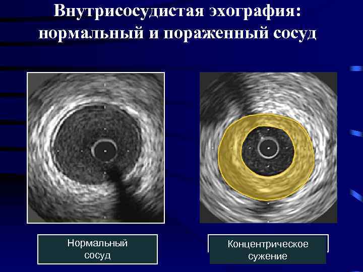 Внутрисосудистая эхография: нормальный и пораженный сосуд Aventitia EEM Border Media Intima Lumen Catheter Guide