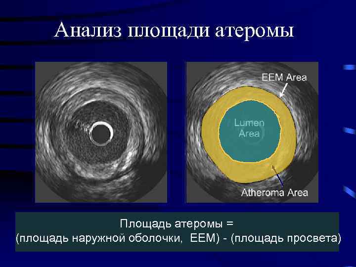 Анализ площади атеромы Площадь атеромы = (площадь наружной оболочки, ЕЕМ) - (площадь просвета) 