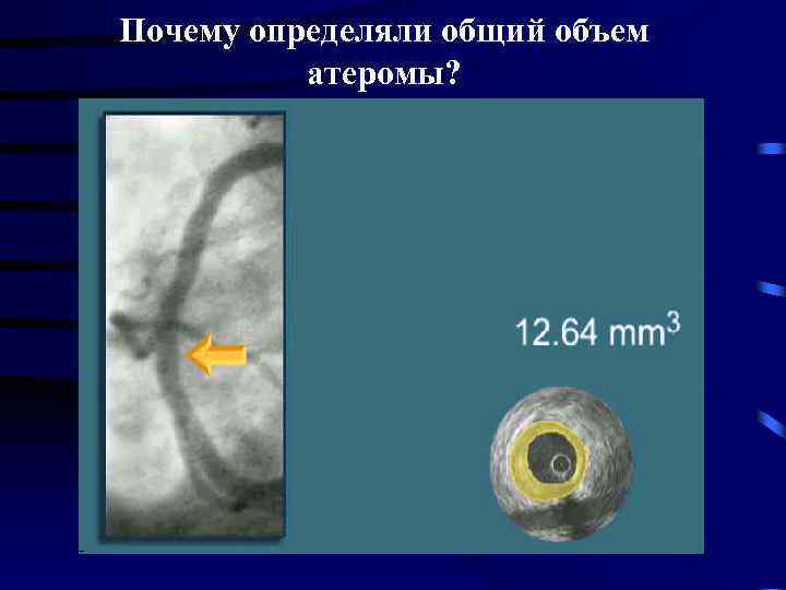 Почему определяли общий объем атеромы? 
