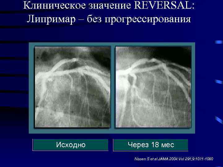 Клиническое значение REVERSAL: Липримар – без прогрессирования Исходно Через 18 мес Nissen S et