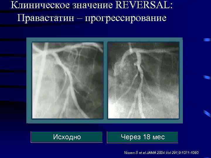 Клиническое значение REVERSAL: Правастатин – прогрессирование Исходно Через 18 мес Nissen S et al.