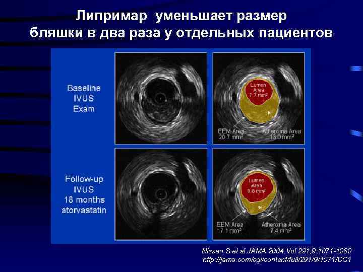 Липримар уменьшает размер бляшки в два раза у отдельных пациентов Nissen S et al.