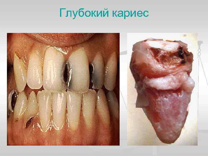 Глубокий кариес 