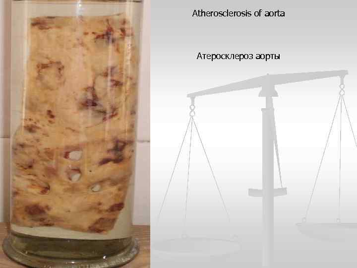 Atherosclerosis of aorta Атеросклероз аорты 