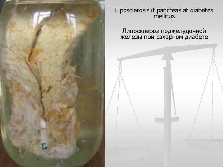 Liposclerosis if pancreas at diabetes mellitus Липосклероз поджелудочной железы при сахарном диабете 