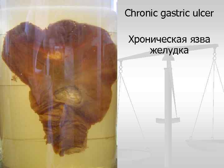 Chronic gastric ulcer Хроническая язва желудка 