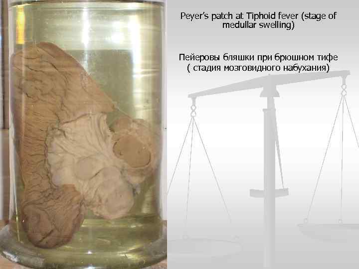 Peyer’s patch at Tiphoid fever (stage of medullar swelling) Пейеровы бляшки при брюшном тифе