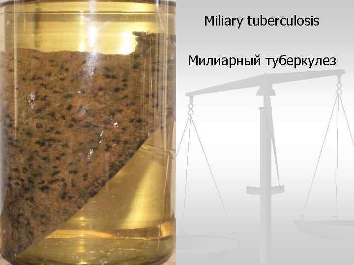 Miliary tuberculosis Милиарный туберкулез 