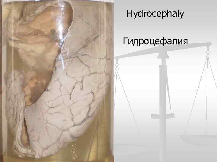 Hydrocephaly Гидроцефалия 