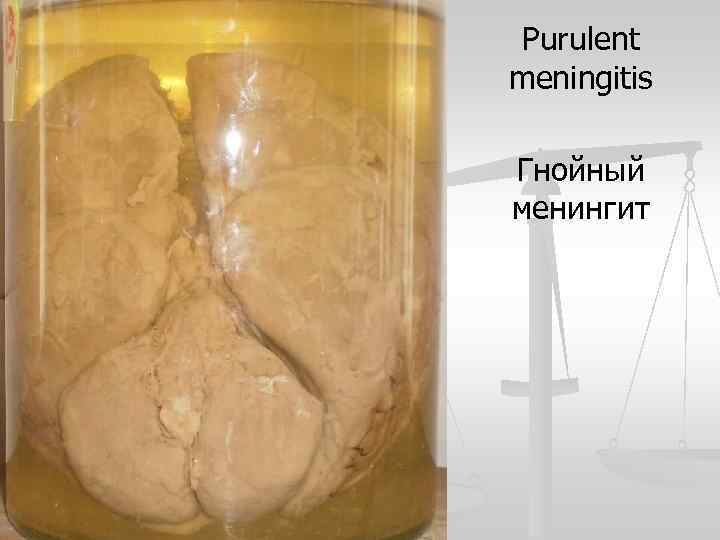 Purulent meningitis Гнойный менингит 