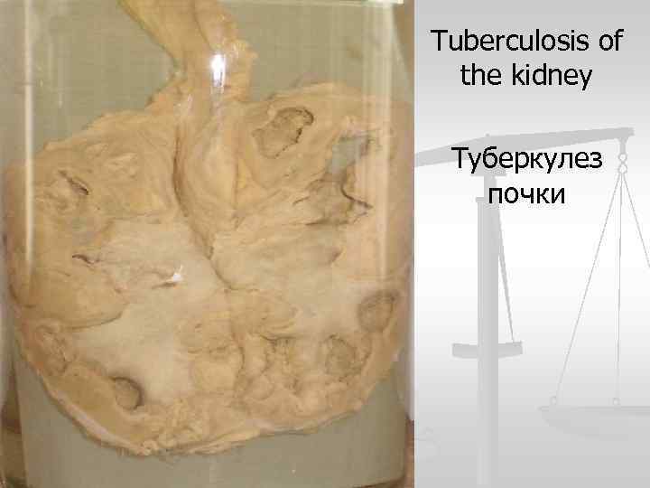 Tuberculosis of the kidney Туберкулез почки 