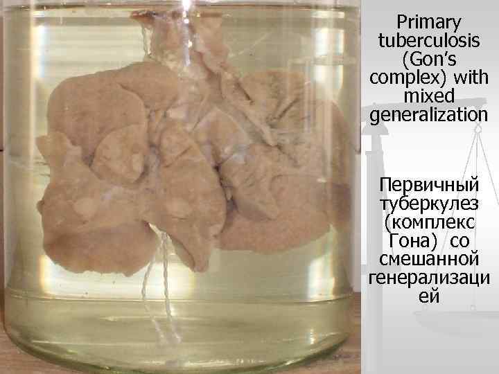Primary tuberculosis (Gon’s complex) with mixed generalization Первичный туберкулез (комплекс Гона) со смешанной генерализаци