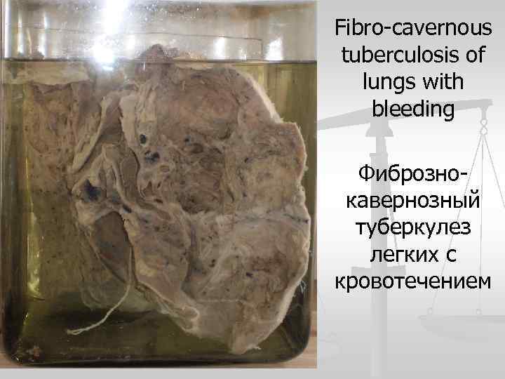 Fibro-cavernous tuberculosis of lungs with bleeding Фибрознокавернозный туберкулез легких с кровотечением 