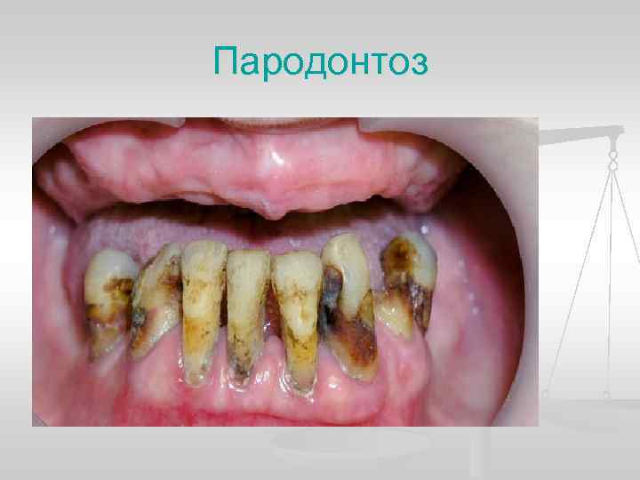Пародонтоз 