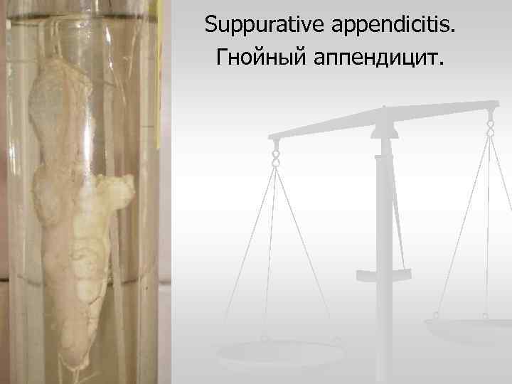 Suppurative appendicitis. Гнойный аппендицит. 