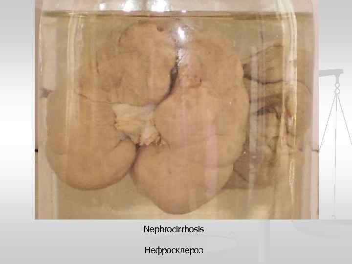 Nephrocirrhosis Нефросклероз 