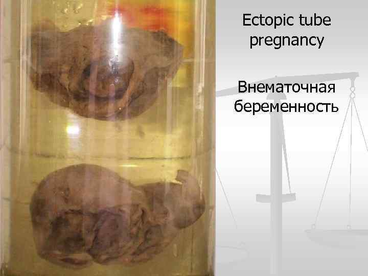 Ectopic tube pregnancy Внематочная беременность 