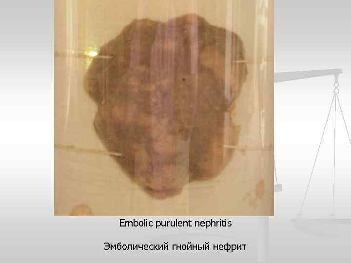 Embolic purulent nephritis Эмболический гнойный нефрит 
